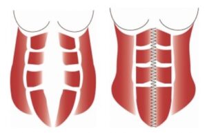 Rectus Abdominis Diastasis The Operative Review Of Surgery