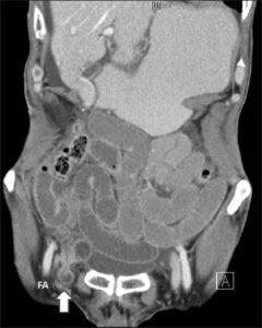 Femoral Hernia The Operative Review Of Surgery