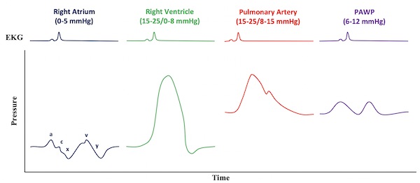 pulmonary artery catheter waveforms