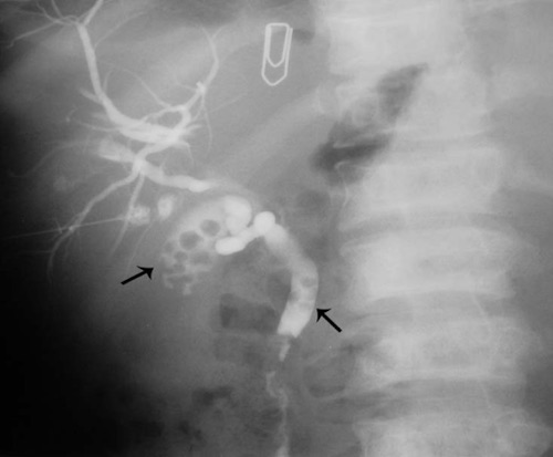 choledocholithiasis ercp