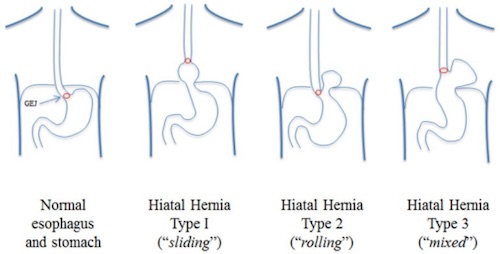 Medium Size Hiatal Hernia