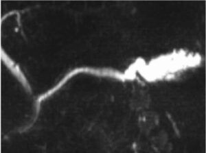 Pancreatic Cystic Neoplasia - The Operative Review Of Surgery