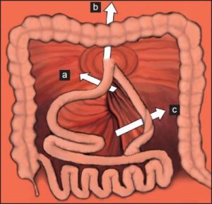 Bariatric Surgery - The Operative Review Of Surgery