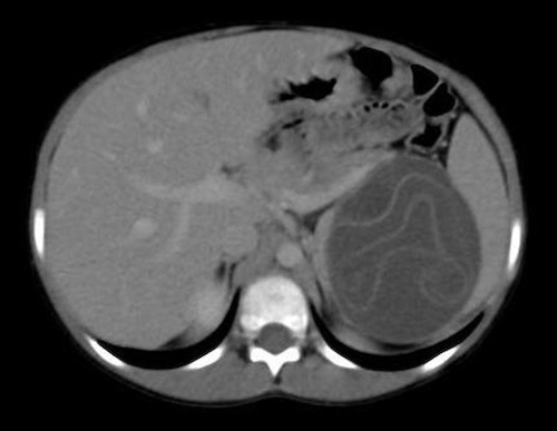 Splenic Cyst The Operative Review Of Surgery