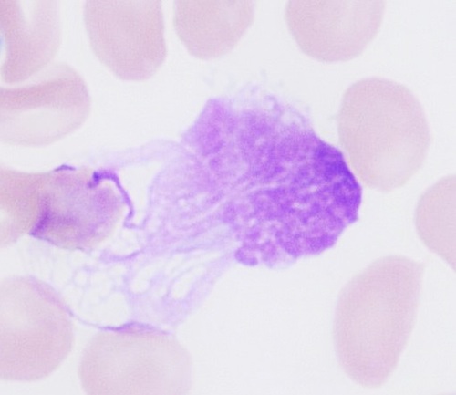 Chronic Lymphocytic Leukemia Smudge Cells