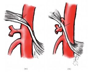 Median Arcuate Ligament Syndrome (MALS) - The Operative Review Of Surgery