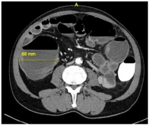 Toxic Megacolon - The Operative Review Of Surgery