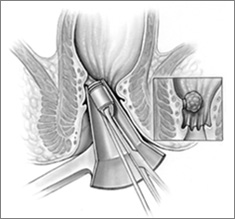 Anorectal: Hemorrhoidal Procedures Hemorrhoid Banding Procedure Placement: Site: Above Dentate Line Band: Redundant Mucosa Only Leave Underlying Pile Mucosa Will Slough Off After 5-7 Days *If Taking Anticoagulation – Band & Then Hold Anticoagulation for 1 Week to Prevent Excess Bleeding with Mucosa Slough Complications Misplaced Band (Below Dentate) Sx: Immediate Pain Tx: Remove Pelvic […]