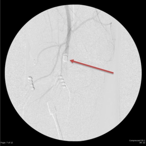 Thoracic Vascular Trauma - The Operative Review Of Surgery