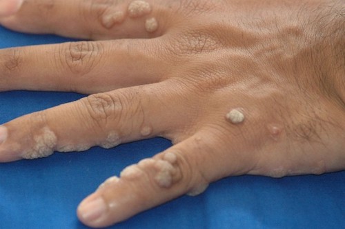 Cutaneous Wart The Operative Review Of Surgery