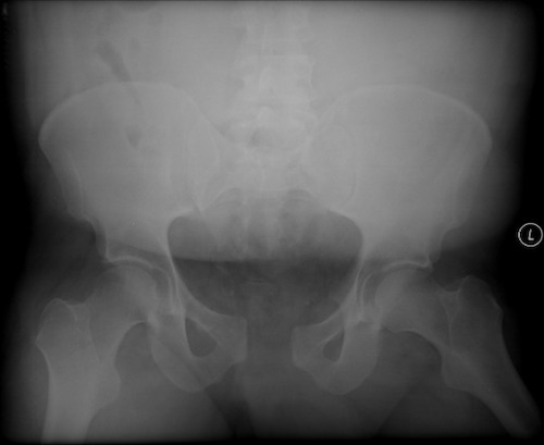 What are open book pelvic fractures?