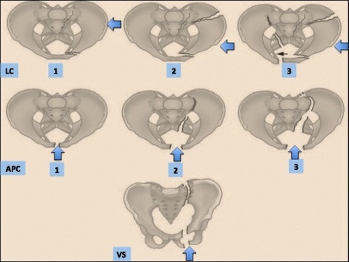 Lateral compression type 1 (LC1) pelvic ring injuries: a spectrum of fracture  types and treatment algorithms | European Journal of Orthopaedic Surgery &  Traumatology