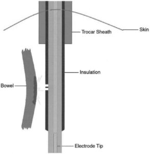 Energy Isolation Failures Surgical Energy - The Operative Review Of Surgery