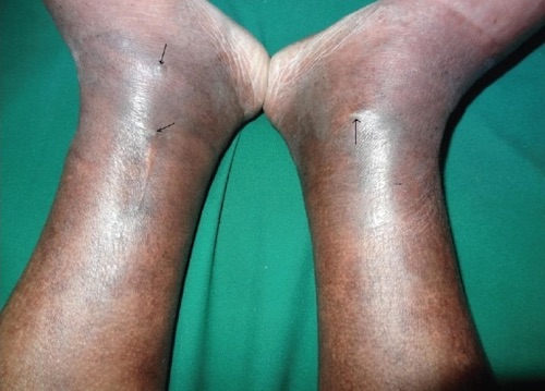 Chronic Venous Insufficiency - The Operative Review Of Surgery