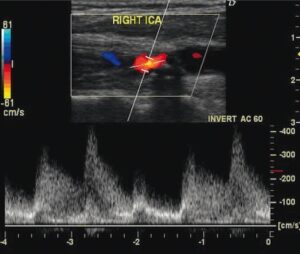 Carotid Artery Stenosis - The Operative Review Of Surgery