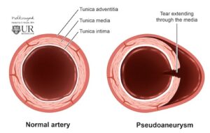 Peripheral Pseudoaneurysm - The Operative Review Of Surgery