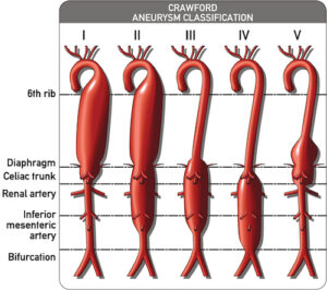 Thoracic Aortic Aneurysm - The Operative Review Of Surgery