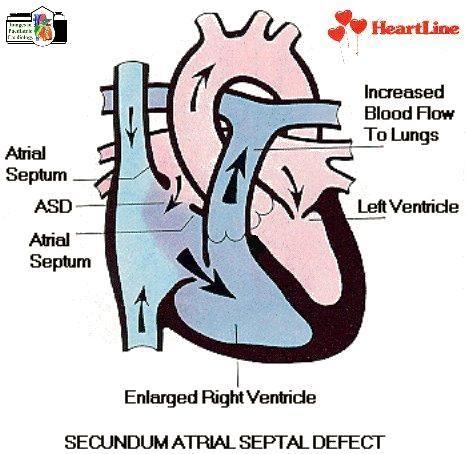 Congenital Heart Disease - The Operative Review Of Surgery