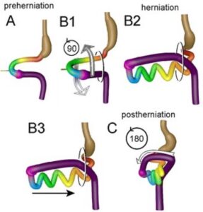 Intestinal Malrotation - The Operative Review Of Surgery