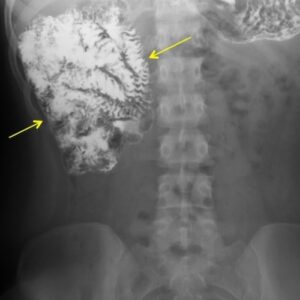 Intestinal Malrotation - The Operative Review Of Surgery