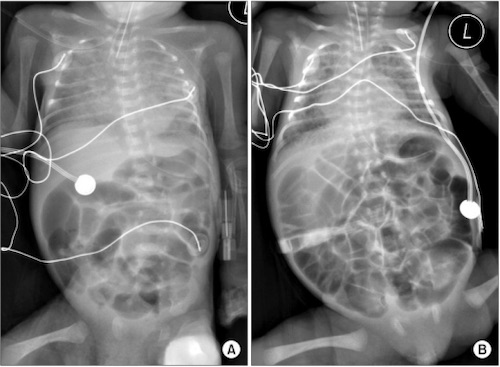 Meconium Ileus Failure To Pass Meconium Diagnosing Neonatal