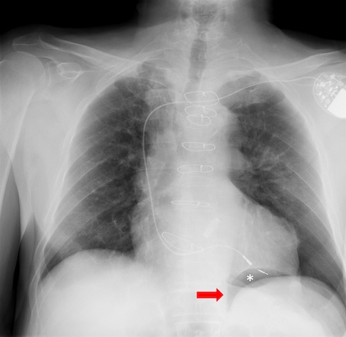 Pulmonary Trauma The Operative Review Of Surgery