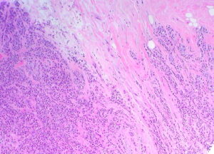 Breast Invasive Carcinoma - The Operative Review Of Surgery