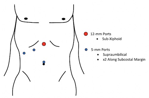 Ascites collected in the drain bag. The appearance of ascites was... |  Download Scientific Diagram