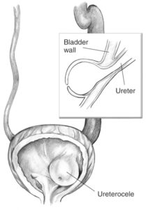 Ureter Anatomic Anomalies - The Operative Review Of Surgery