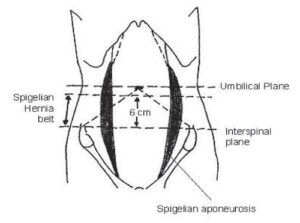 Ventral Hernia - The Operative Review Of Surgery